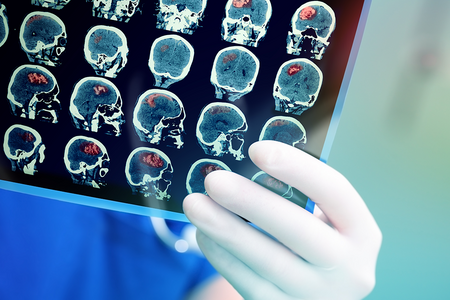 white gloved hand holding xray film with a series of mri brain images